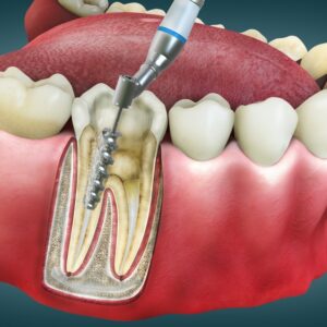 Endodontic - Image 1